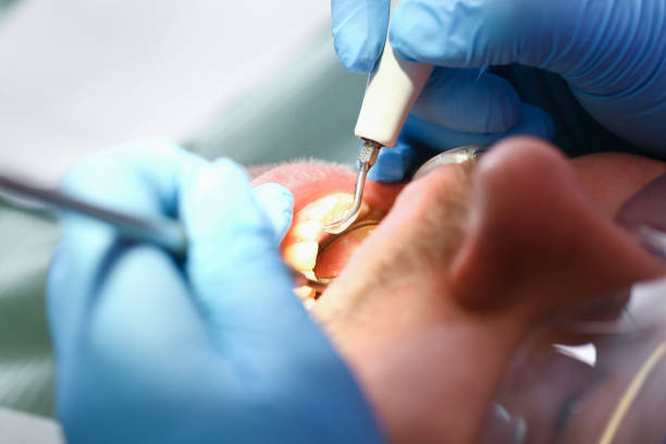 Best Emergency Wisdom Tooth Extraction in Boaz, WV