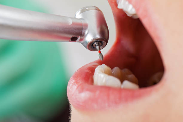 Best Lost Filling or Crown Replacement in Boaz, WV